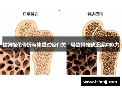 霍姆格伦骨折与体重过轻有关，导致骨骼缺乏缓冲能力